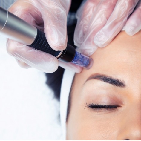 Dermapen facial con microexfoliacion