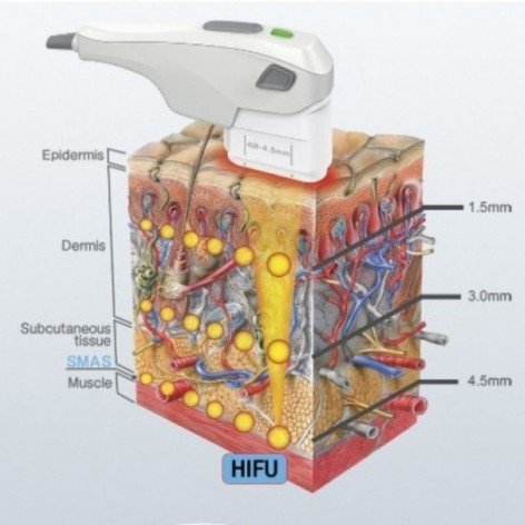 Hifu facial 4D
