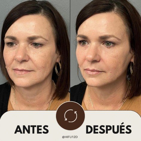 HIFU 12D Facial - Ultrasonidos Focalizados MPT