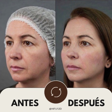 HIFU 12D Facial - Ultrasonidos Focalizados MPT