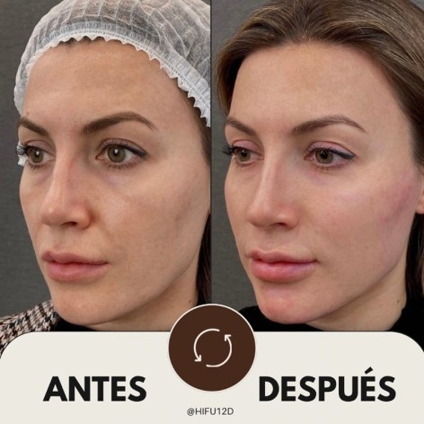 HIFU 12D Facial - Ultrasonidos Focalizados MPT