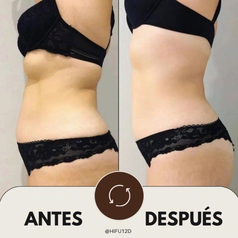 HIFU 12D Corporal - Ultrasonidos Focalizados MPT