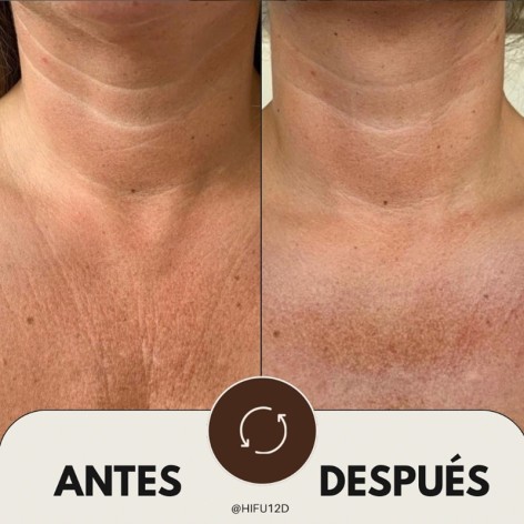 HIFU 12D Corporal - Ultrasonidos Focalizados MPT