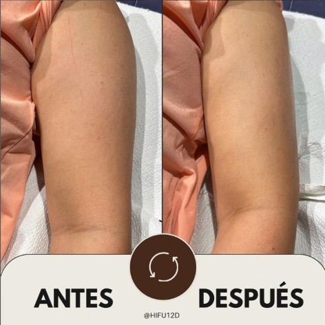 HIFU 12D Corporal - Ultrasonidos Focalizados MPT