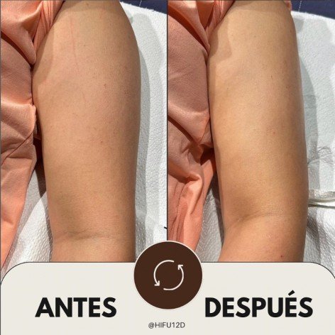 Reafirm Body Pro - Pack Remodelación Corporal con EVO 3D + HIFU 7D y 12 D - Promo Especial