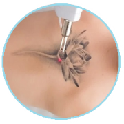 Eliminación de tatuajes con láser - Clínicas estéticas Bellezzia